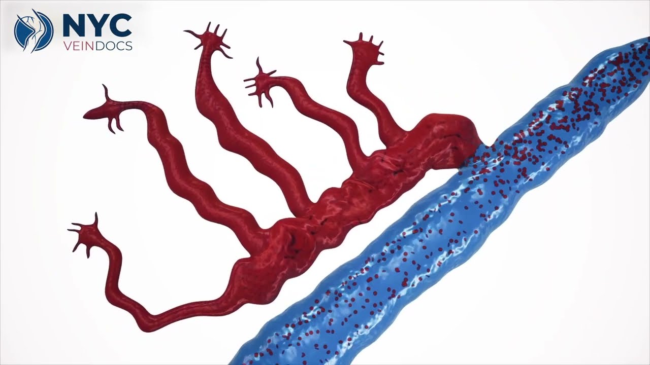 What is Venus Reflux? |  NYC Vein Docs