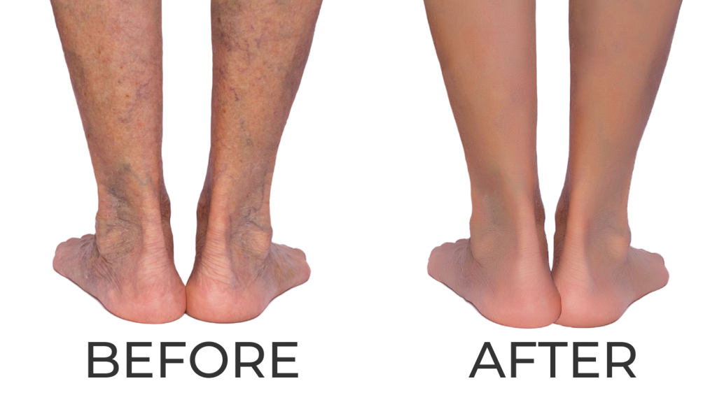 Venous Insufficiency Treatments in Brooklyn, New York - Vascular