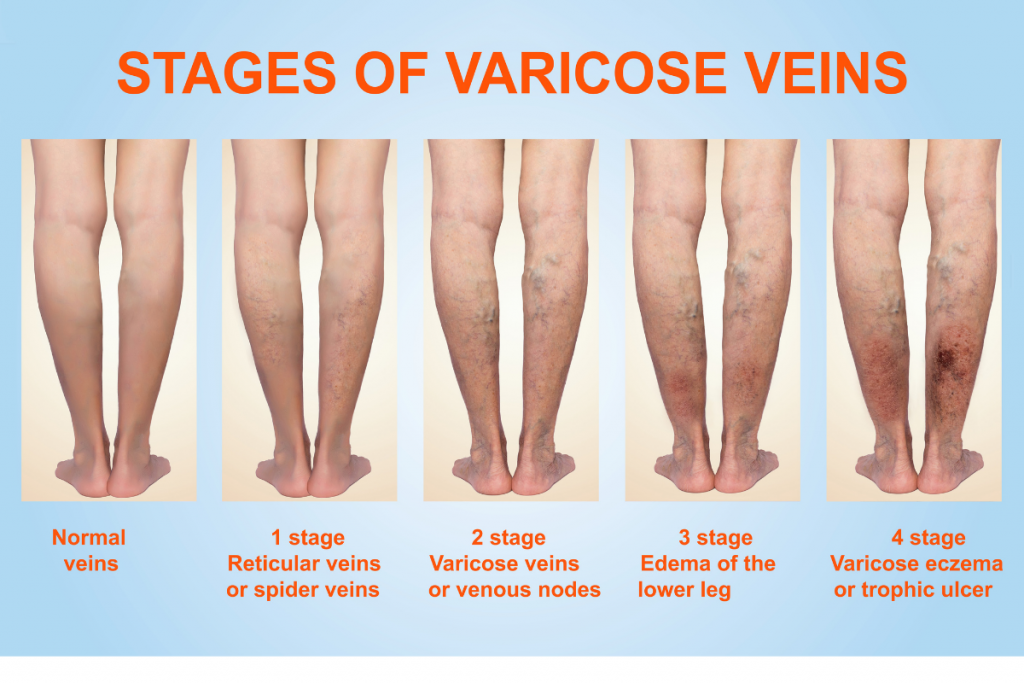 Top 3 Signs of Vein Disease (do you have it?) - NYC Vein Docs